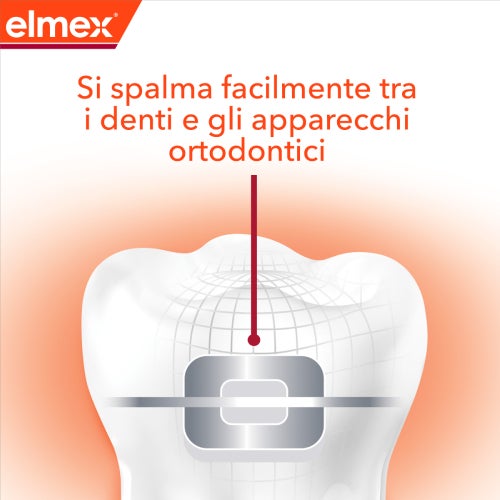 Dente con apparecchio ortodontico che mostra come il dentifricio si spalma facilmente tra i denti e l’apparecchio.